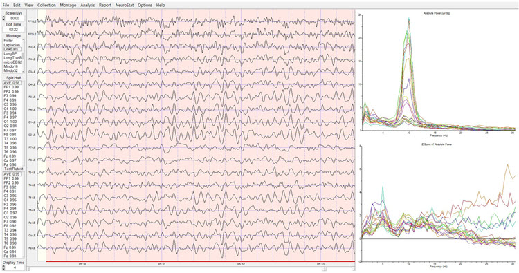 Dynamic z-score FFT eyes-closed post-training showing improved 10 Hz peak frequency